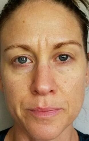 At 40, deep wrinkles and age spots appeared