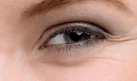 Wrinkles on the corners of the eyes